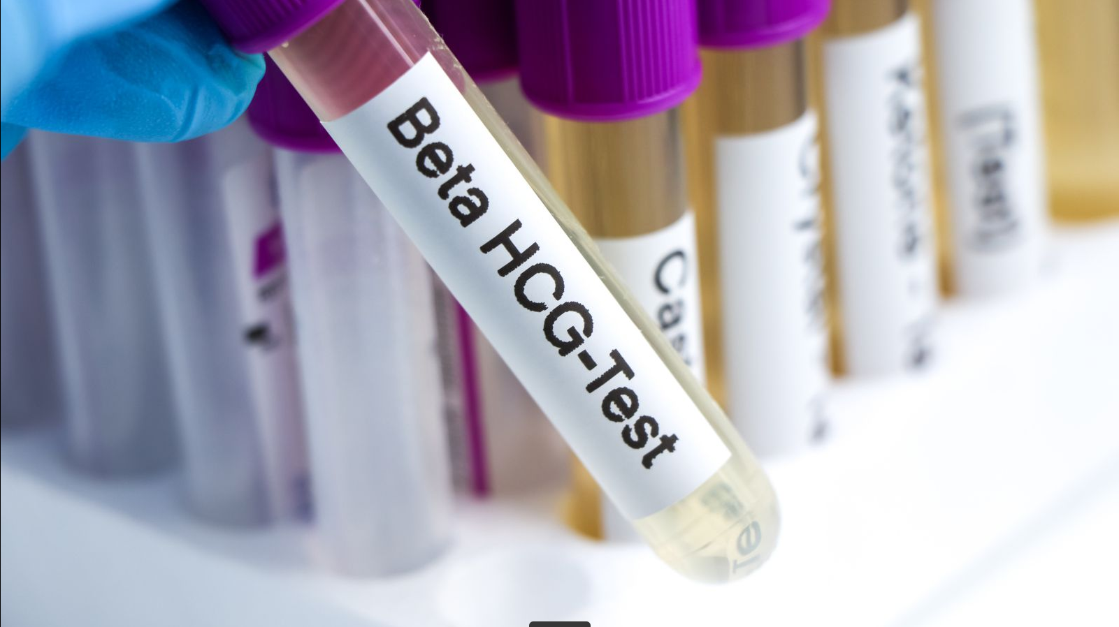 Provetta di laboratorio con etichetta Beta HCG-Test tenuta da un operatore con guanti blu per analisi di gravidanza.
