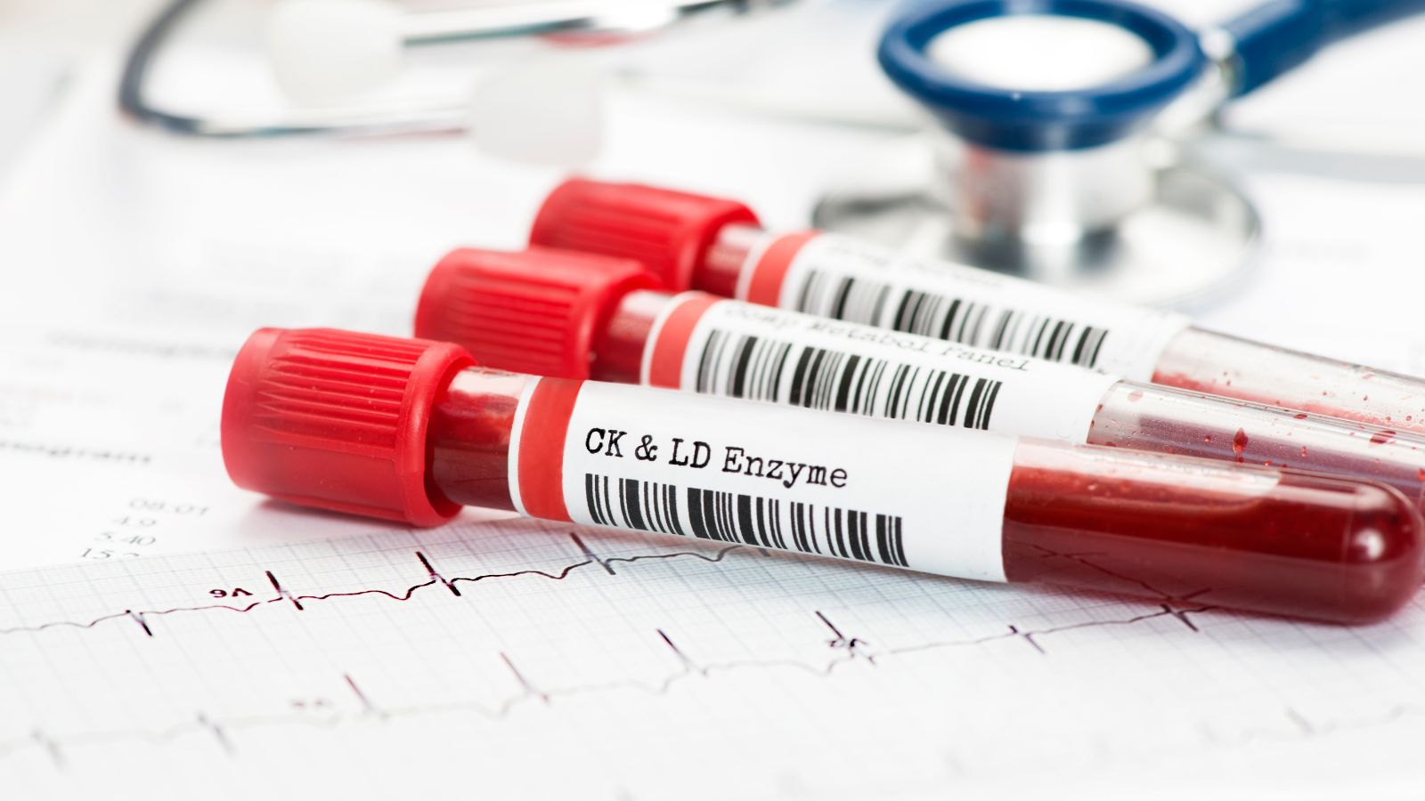 Provette per dosaggio ematico di creatinchinasi e isoenzimi CK su tracciato elettrocardiografico presso il Poliambulatorio Exacta a Modena